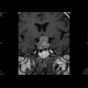 Adenoma of the hypophysis: MRI - Magnetic Resonance Imaging
